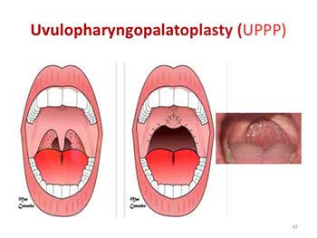 snoring how reduce The   Surgery Examining Snoring Snoring Types Mouthpiece