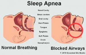 SleepApnea