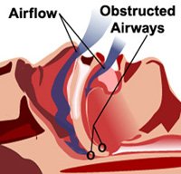 sleep-apnea-diagram